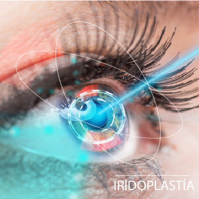 Tratamiento Glaucoma Iridoplastia