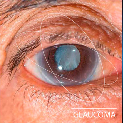 Tratamiento Glaucoma Definición 