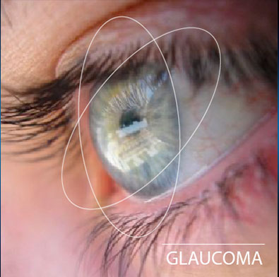 Tratamiento Glaucoma Ojos 