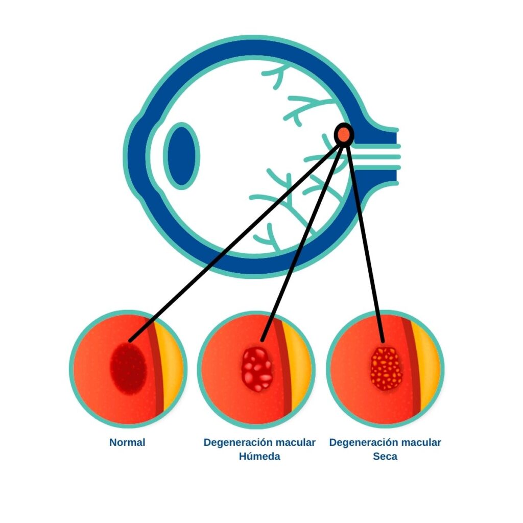 Degeneración Macular Tipos 