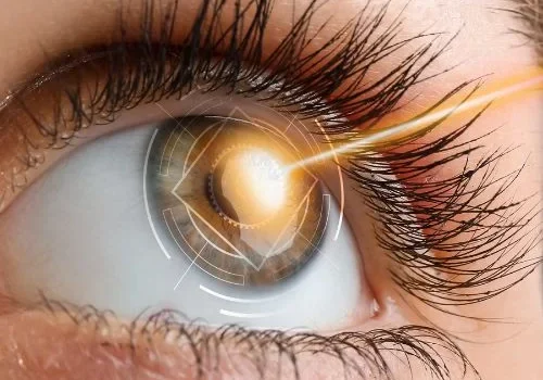 cirugia refractiva img1