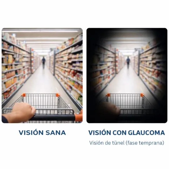 tipo de vision glaucoma