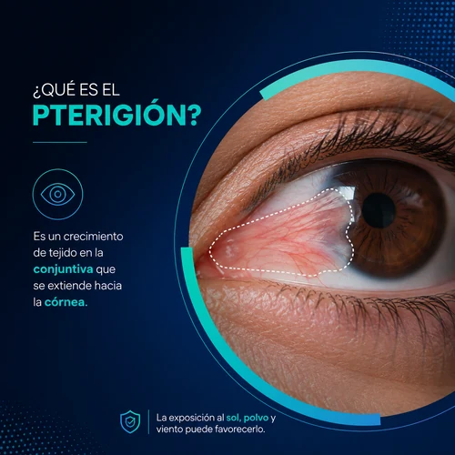 que es pterigion