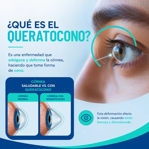 que es queratocono