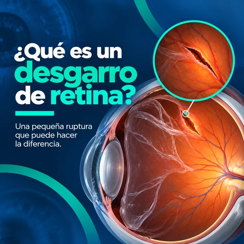 que es desgarro de retina